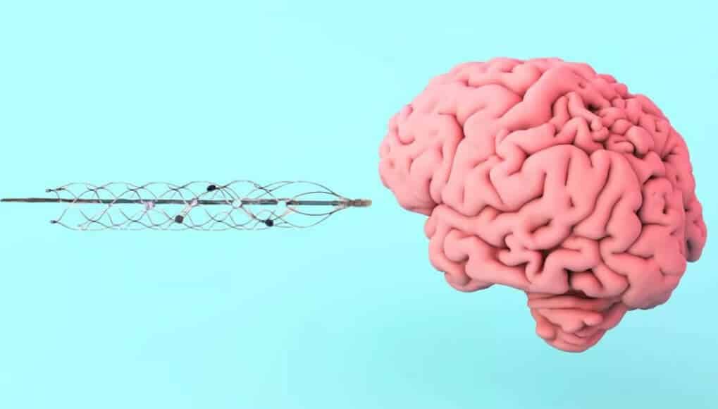 Elon Musk's Neuralink gets FDA approval for human trials 3 What does Neuralink do